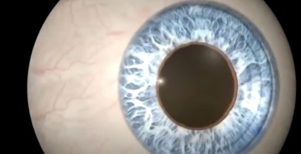 Wavefront lasik surgery 