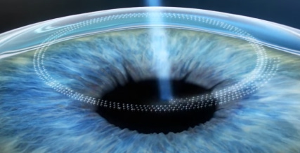 Femto LASIK