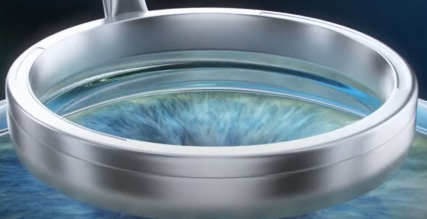 Photorefractive Keratectomy (PRK)